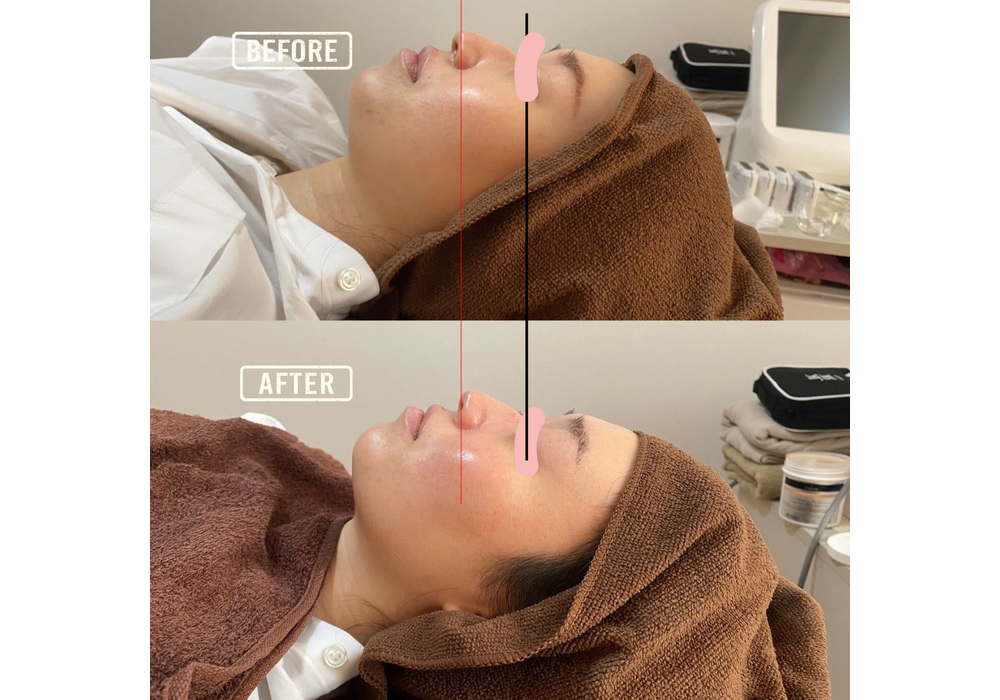 フェイシャル