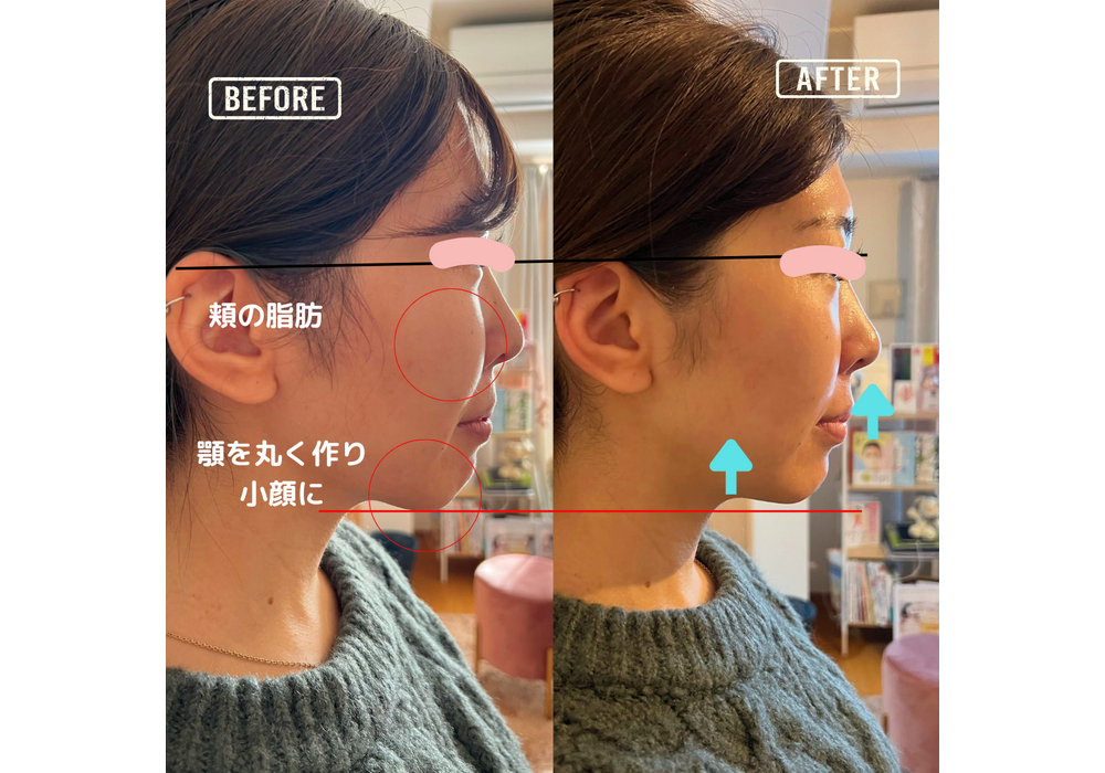 フェイシャル
