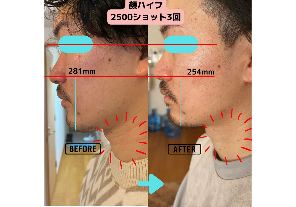 フェイシャルハイフ