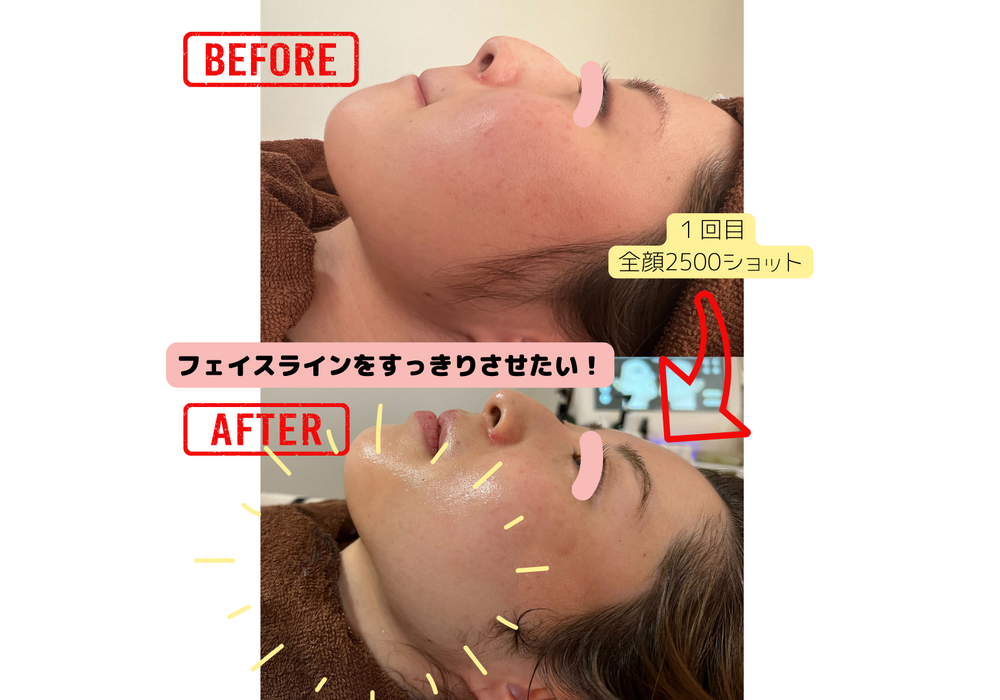 フェイシャル