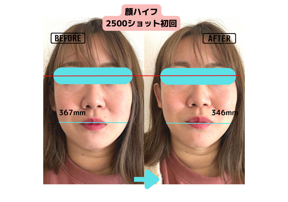 フェイシャル